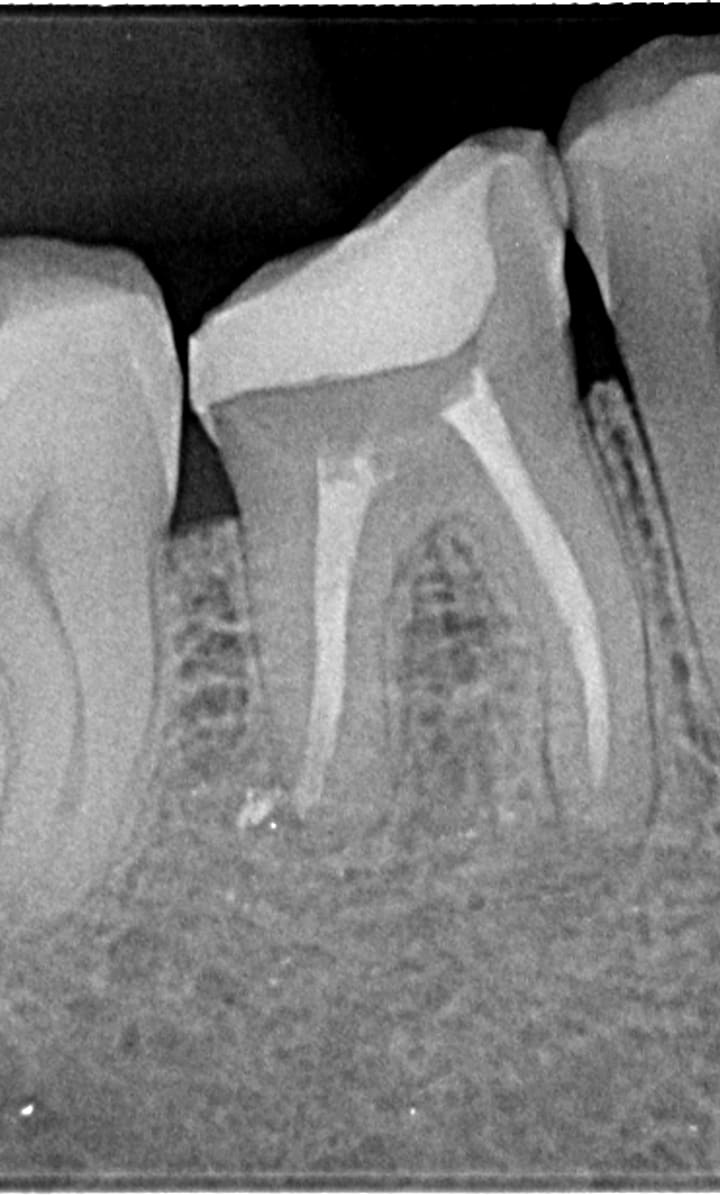 Radiografia inicial · molar inferior