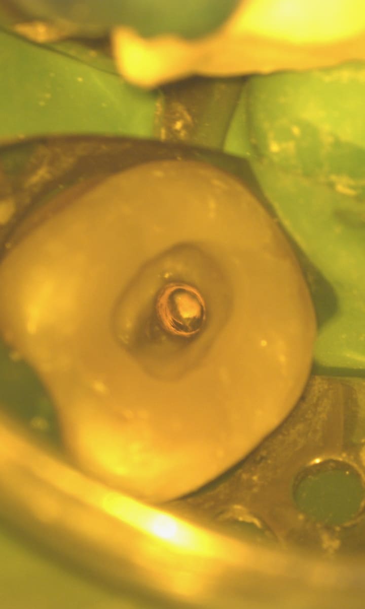 Microscopia · obturação finalizada e conduto preparado para pino