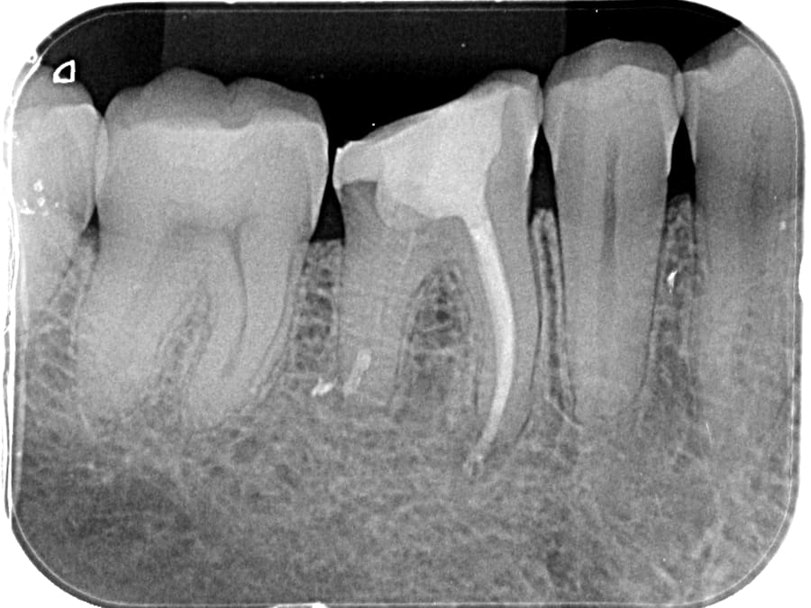 Radiografia final · canal concluído